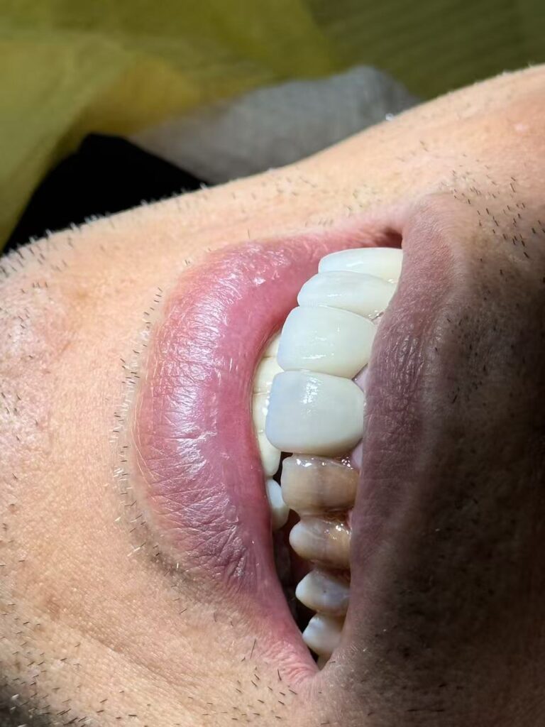 veneers veneers