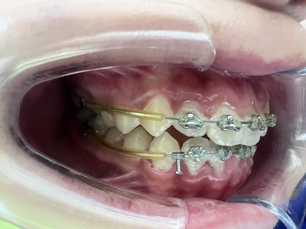 fastbracesmetadentalgroup